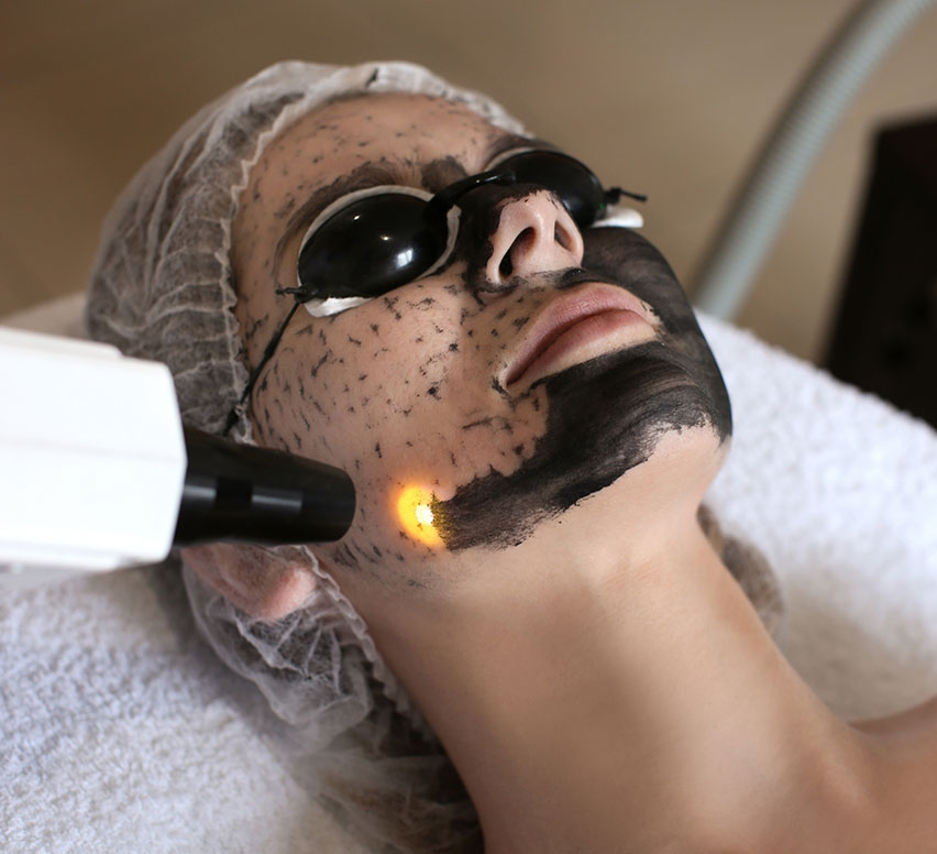 Best Carbon Peel in Delhi