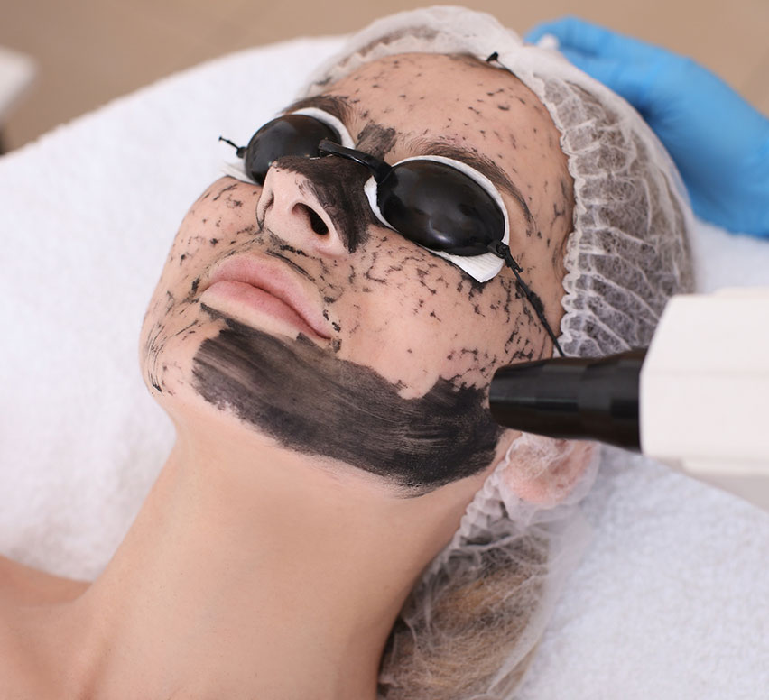 Best Carbon Peel in Delhi