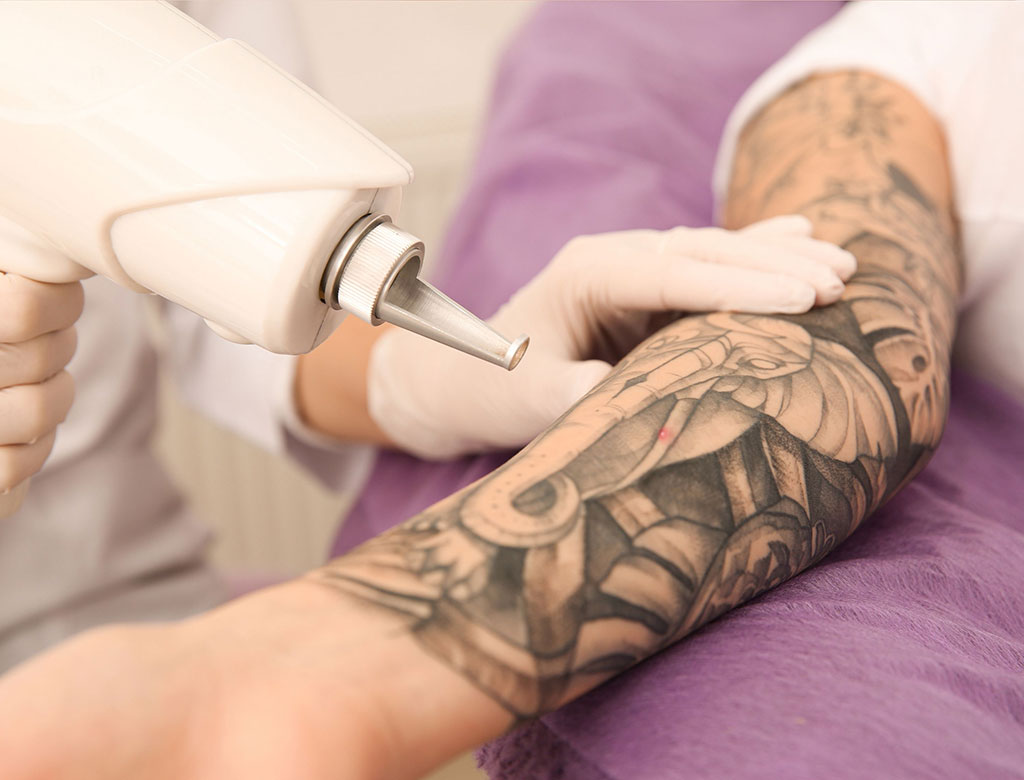 Laser Tattoo Removal nd yag laser