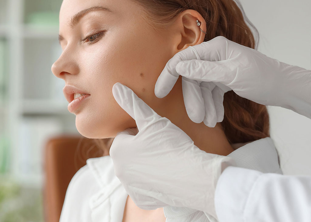 mole removal treatment