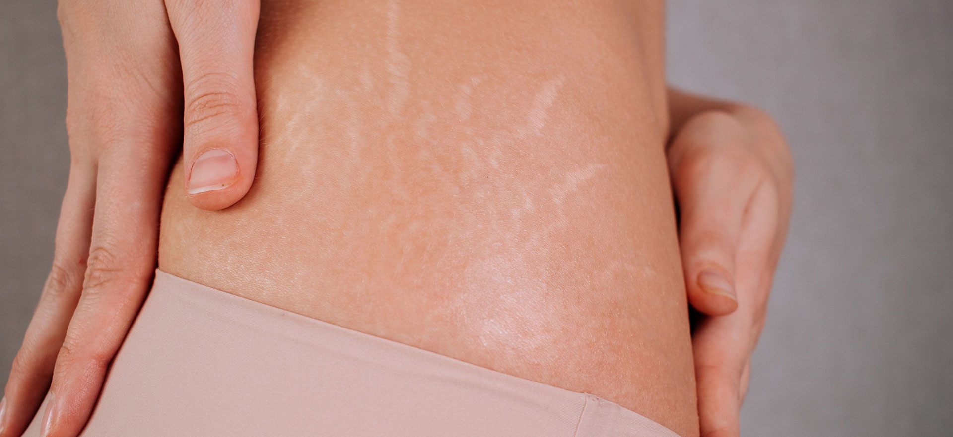 stretch marks removal